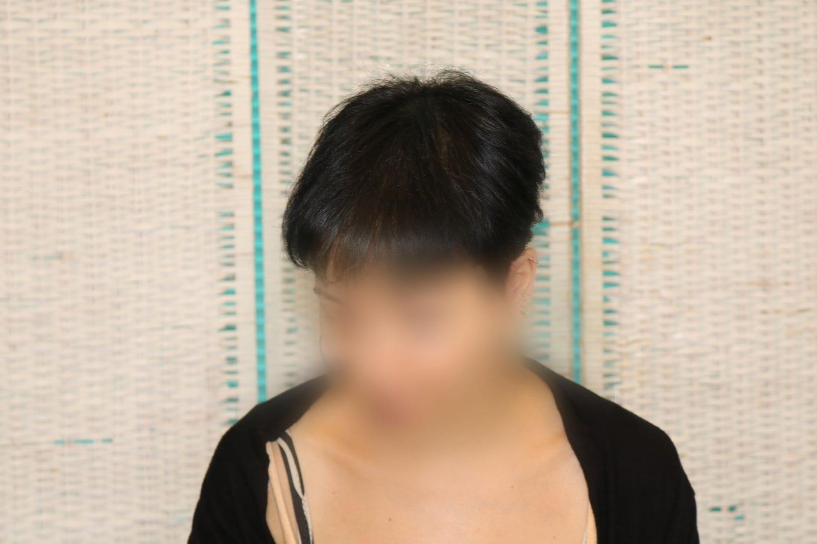 Dopo: tricopigmentazione sezione donna a Firenze — Caso Prima / Dopo #12 (foto 6)