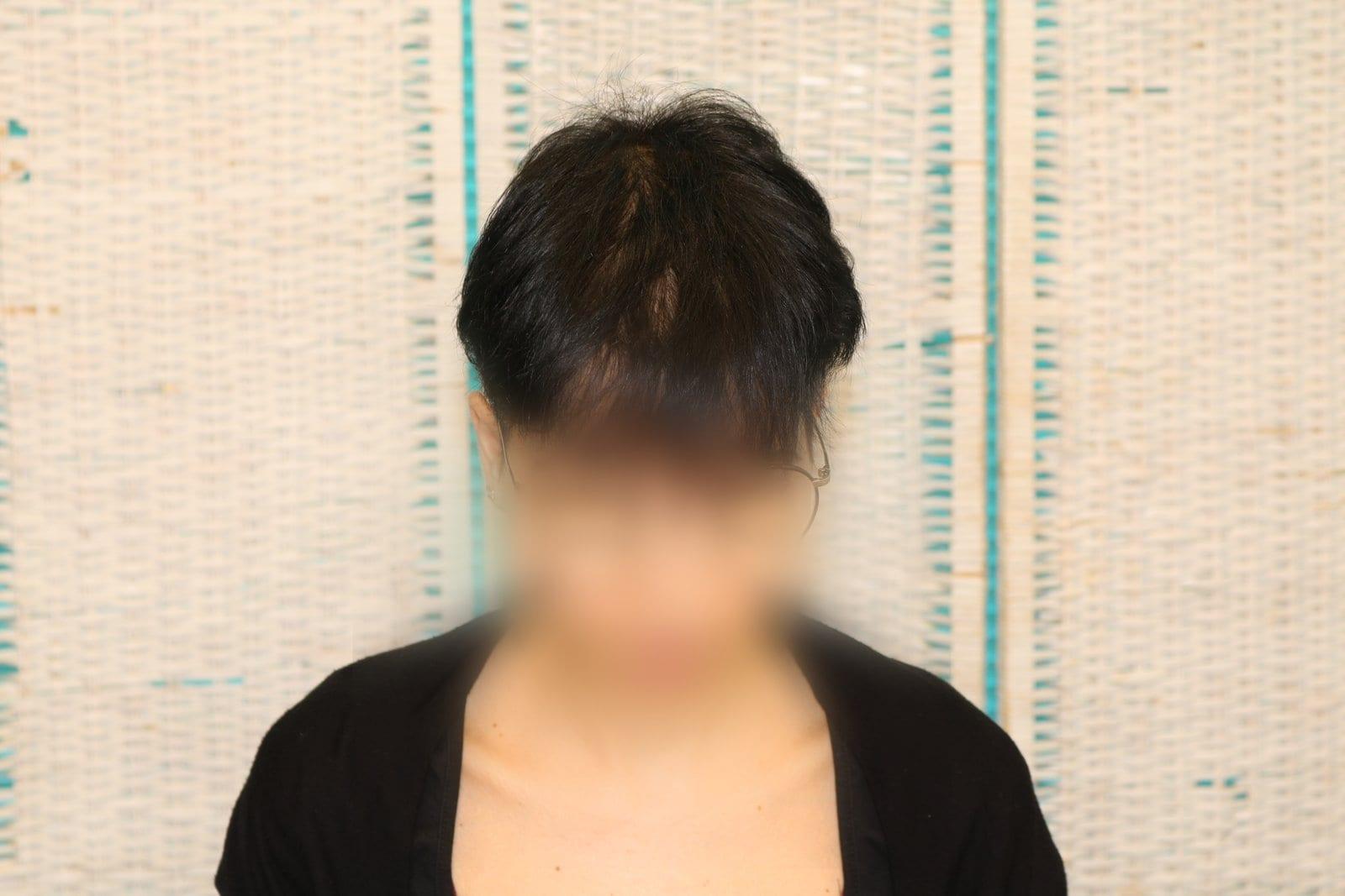 Prima: tricopigmentazione sezione donna a Firenze — Caso Prima / Dopo #12 (foto 1)