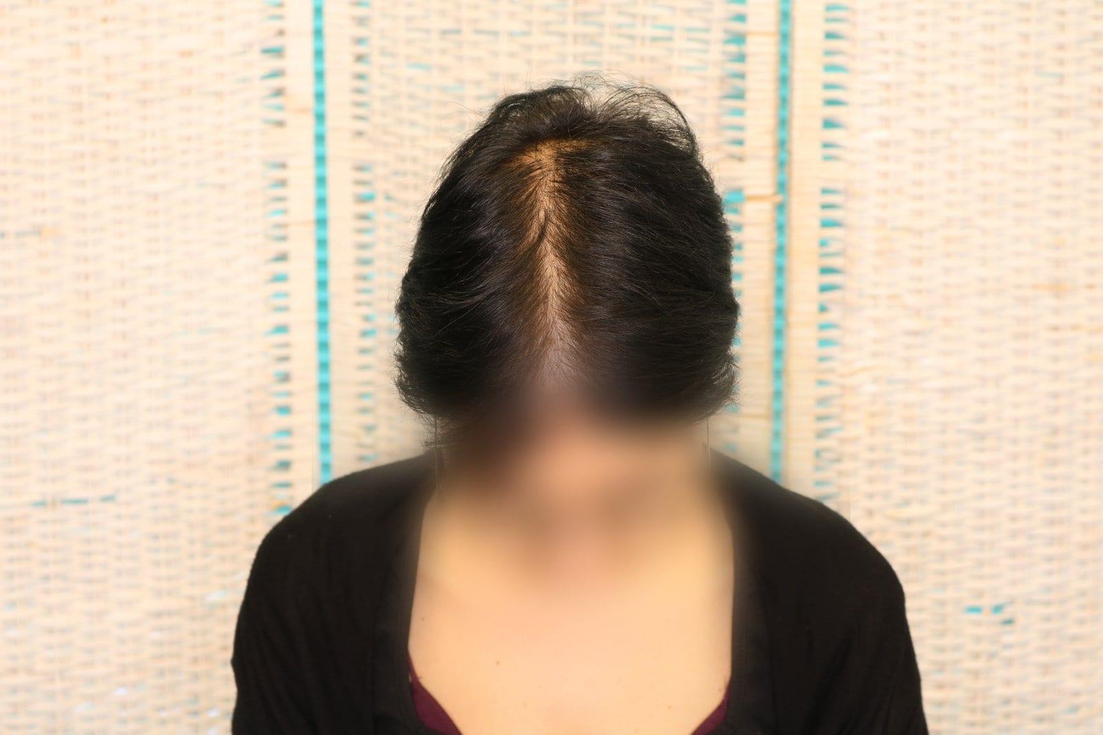 Prima: tricopigmentazione sezione donna a Firenze — Caso Prima / Dopo #12 (foto 2)