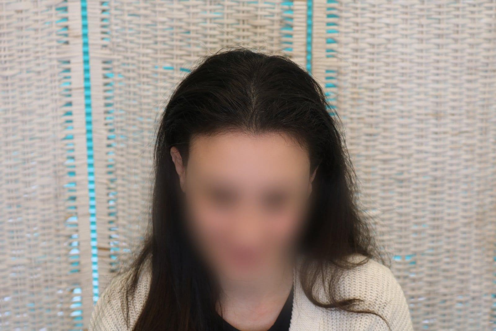 Dopo: tricopigmentazione sezione donna a Firenze — Caso Prima / Dopo #13 (foto 2)