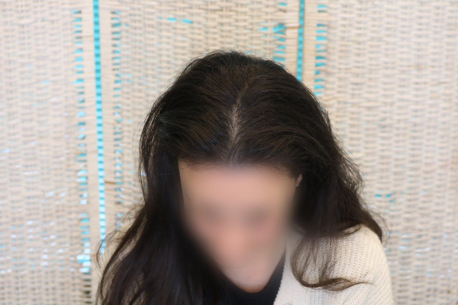 Dopo: tricopigmentazione sezione donna a Firenze — Caso Prima / Dopo #13 (foto 3)
