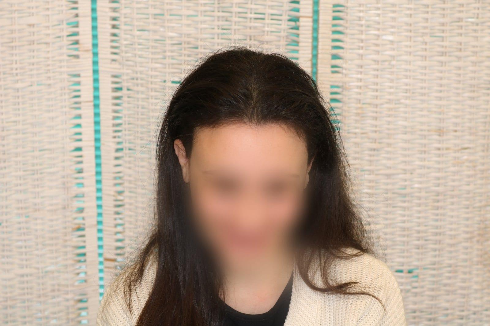 Dopo: tricopigmentazione sezione donna a Firenze — Caso Prima / Dopo #13 (foto 4)