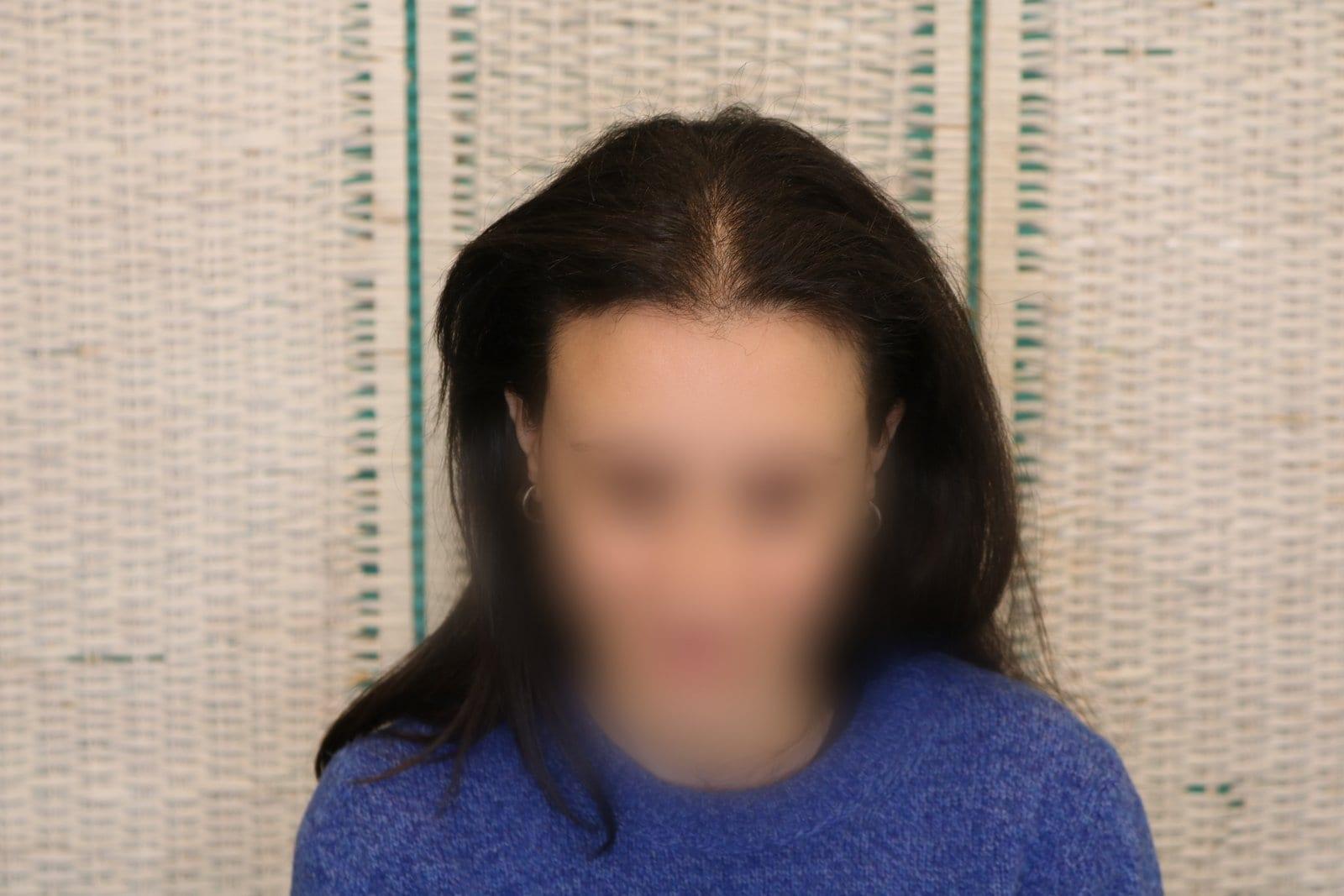 Prima: tricopigmentazione sezione donna a Firenze — Caso Prima / Dopo #13 (foto 1)