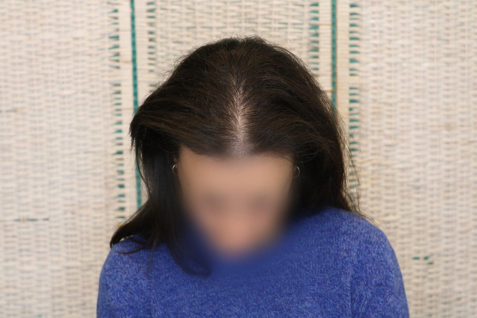 Prima: tricopigmentazione sezione donna a Firenze — Caso Prima / Dopo #13 (foto 2)