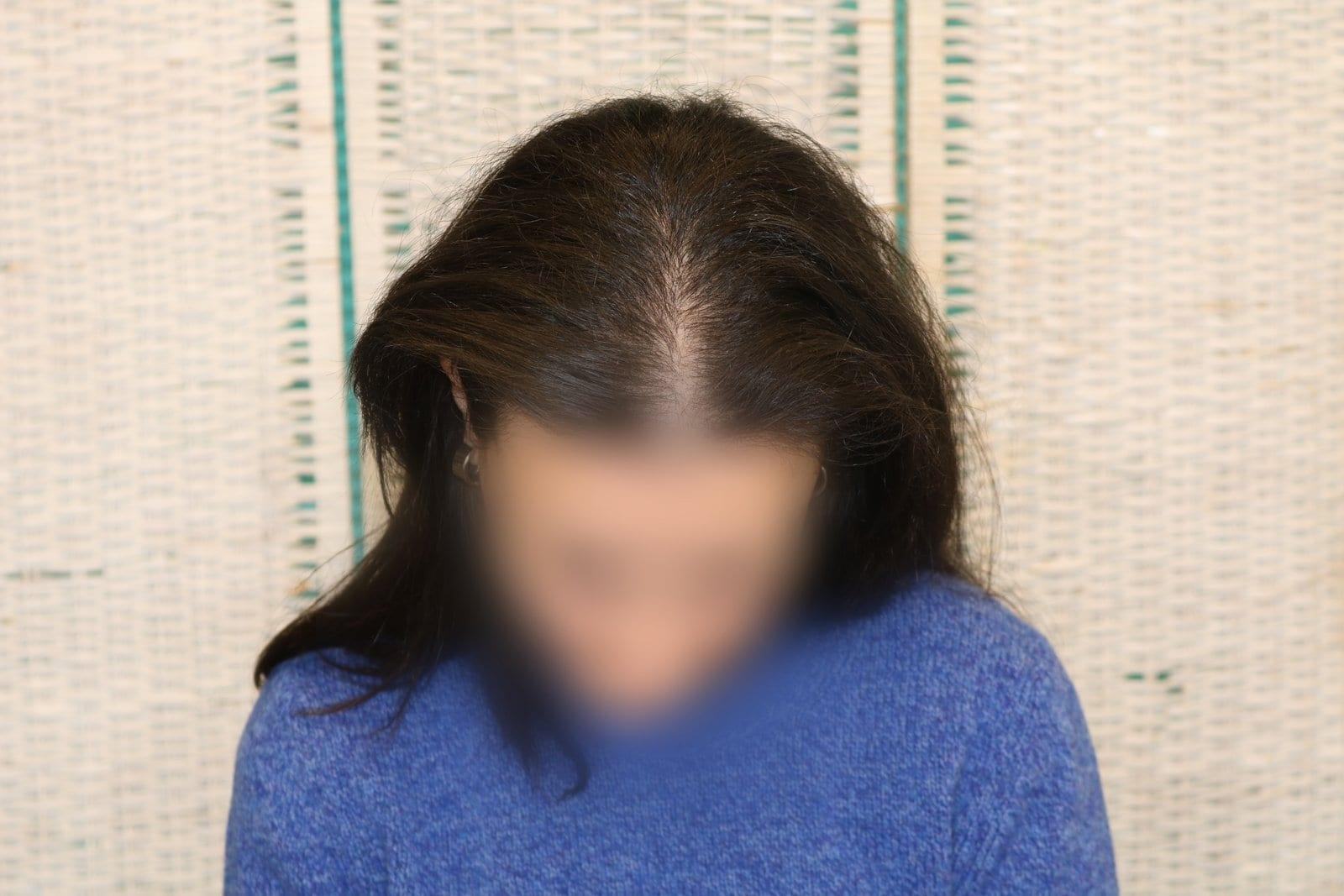 Prima: tricopigmentazione sezione donna a Firenze — Caso Prima / Dopo #13 (foto 4)