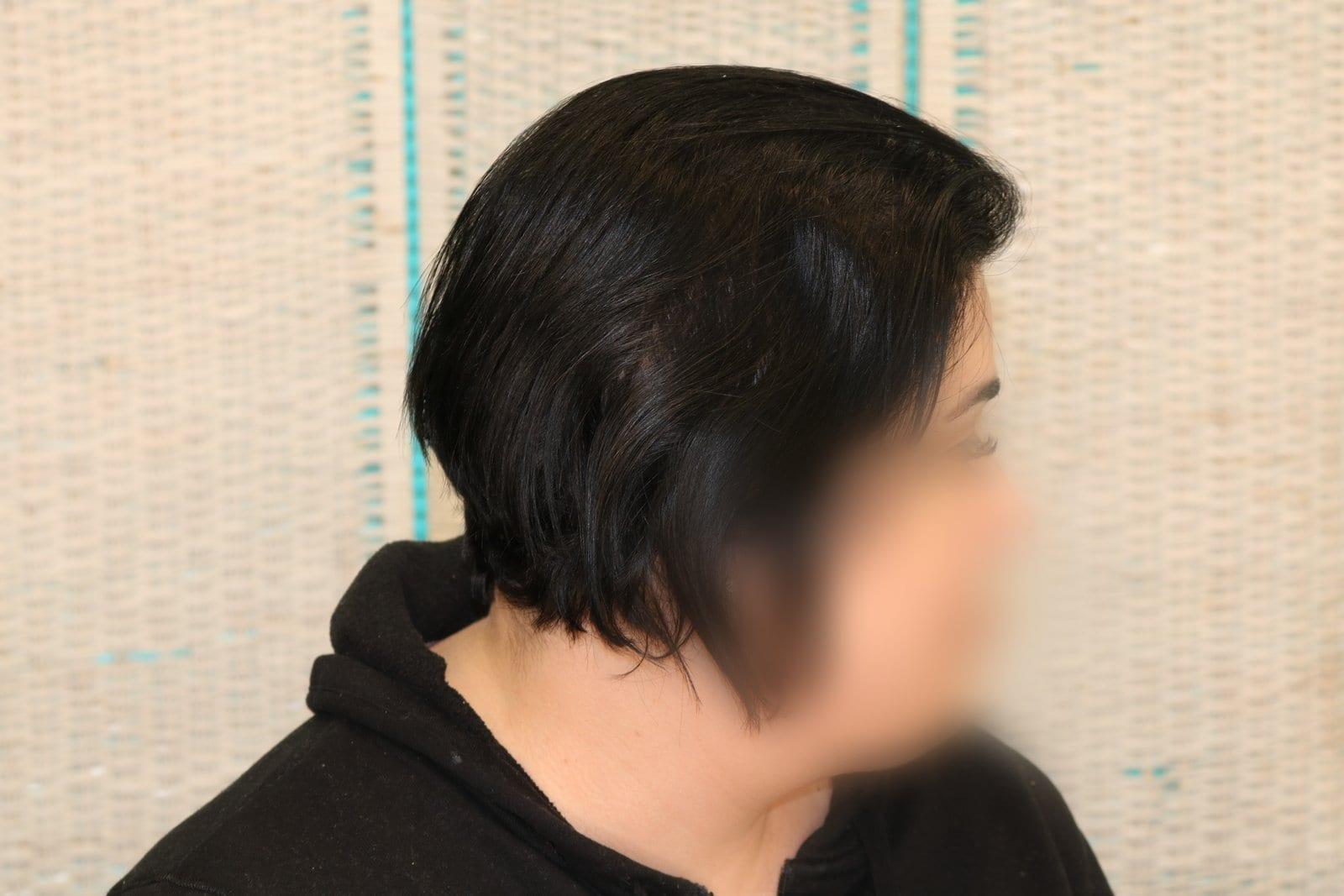 Dopo: tricopigmentazione sezione donna a Firenze — Caso Prima / Dopo #14 (foto 10)