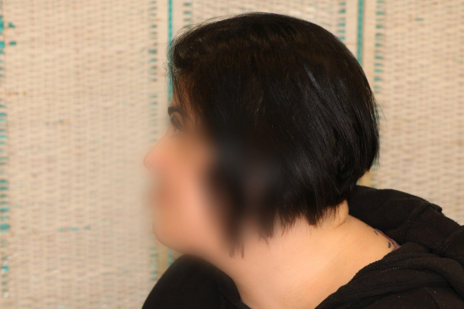 Dopo: tricopigmentazione sezione donna a Firenze — Caso Prima / Dopo #14 (foto 2)