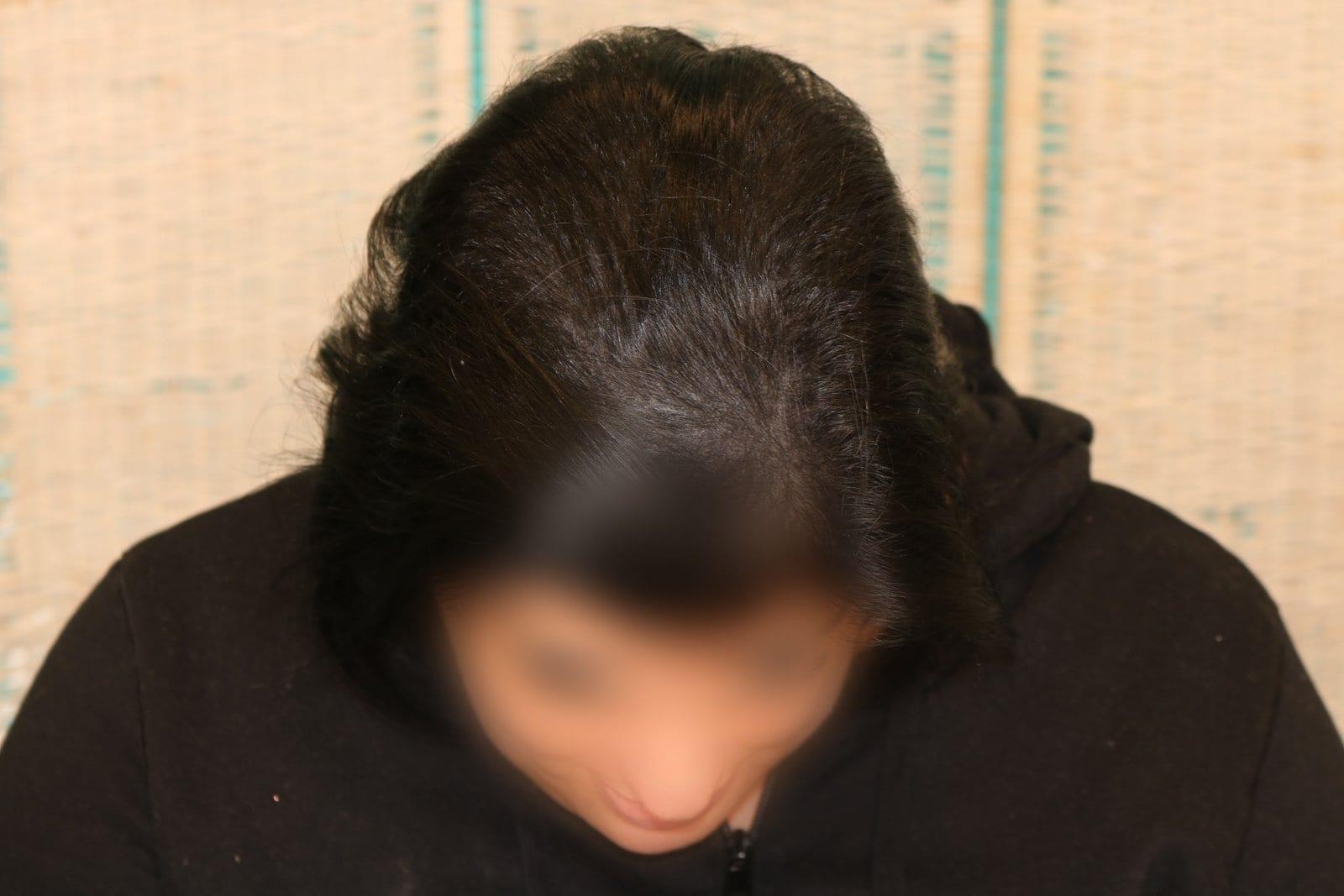 Dopo: tricopigmentazione sezione donna a Firenze — Caso Prima / Dopo #14 (foto 3)