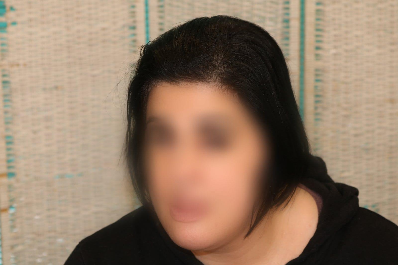 Dopo: tricopigmentazione sezione donna a Firenze — Caso Prima / Dopo #14 (foto 7)