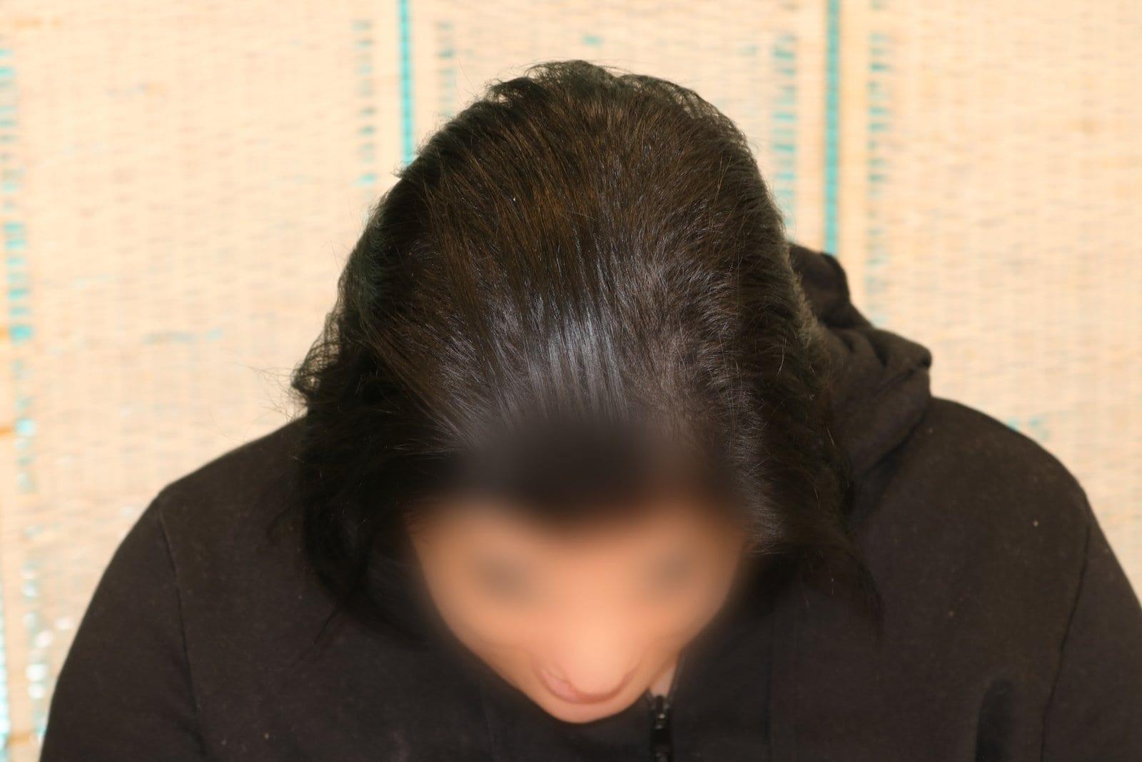 Dopo: tricopigmentazione sezione donna a Firenze — Caso Prima / Dopo #14 (foto 9)