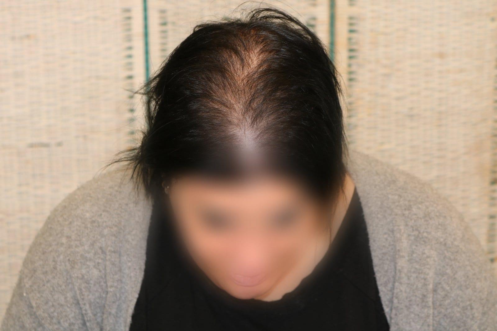 Prima: tricopigmentazione sezione donna a Firenze — Caso Prima / Dopo #14 (foto 1)