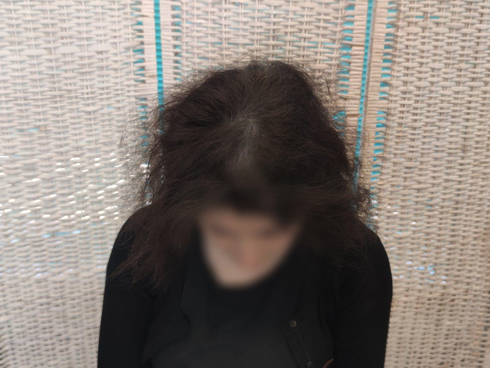 Dopo: tricopigmentazione sezione donna a Firenze — Caso Prima / Dopo #15 (foto 2)