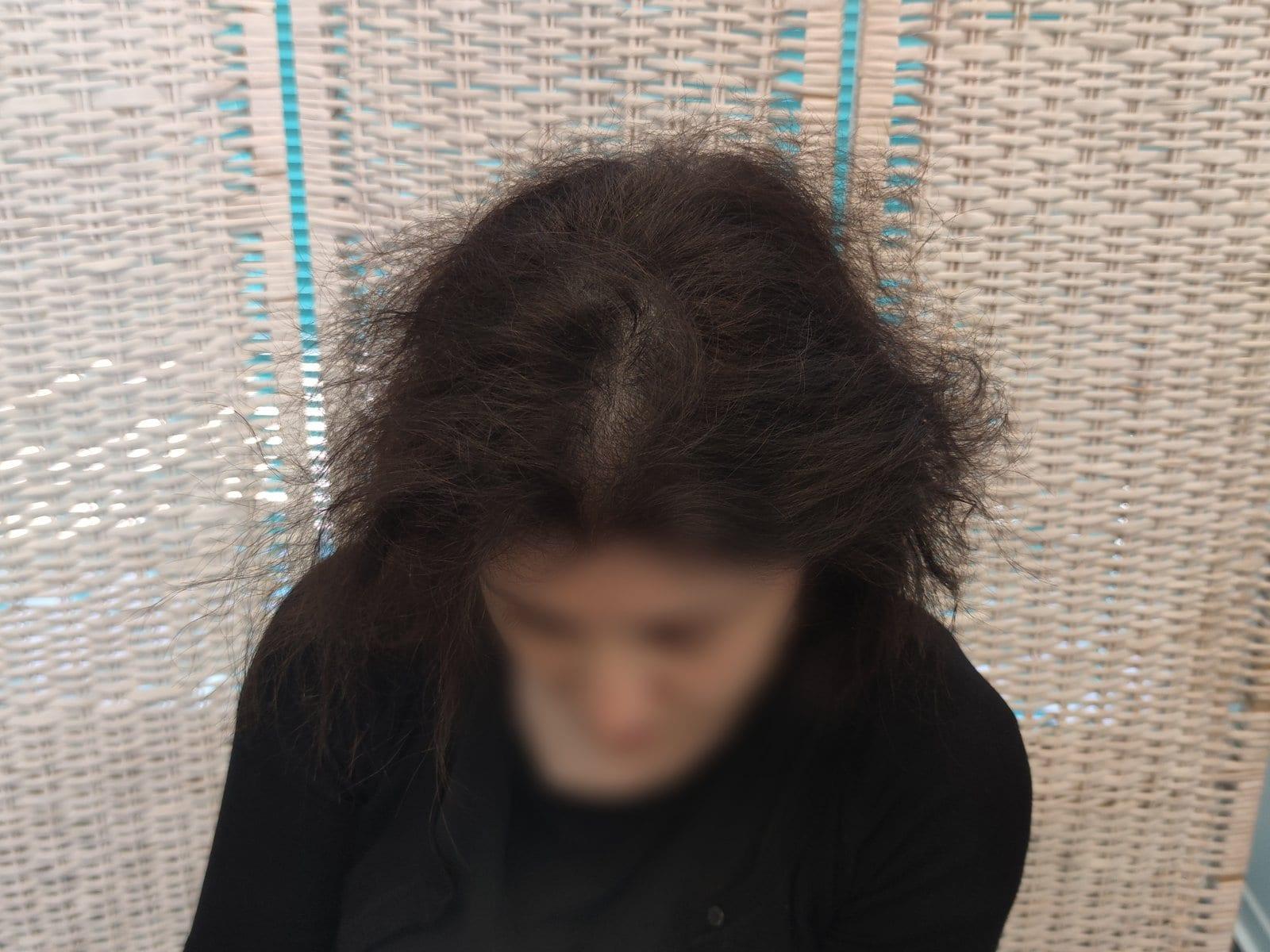 Dopo: tricopigmentazione sezione donna a Firenze — Caso Prima / Dopo #15 (foto 4)