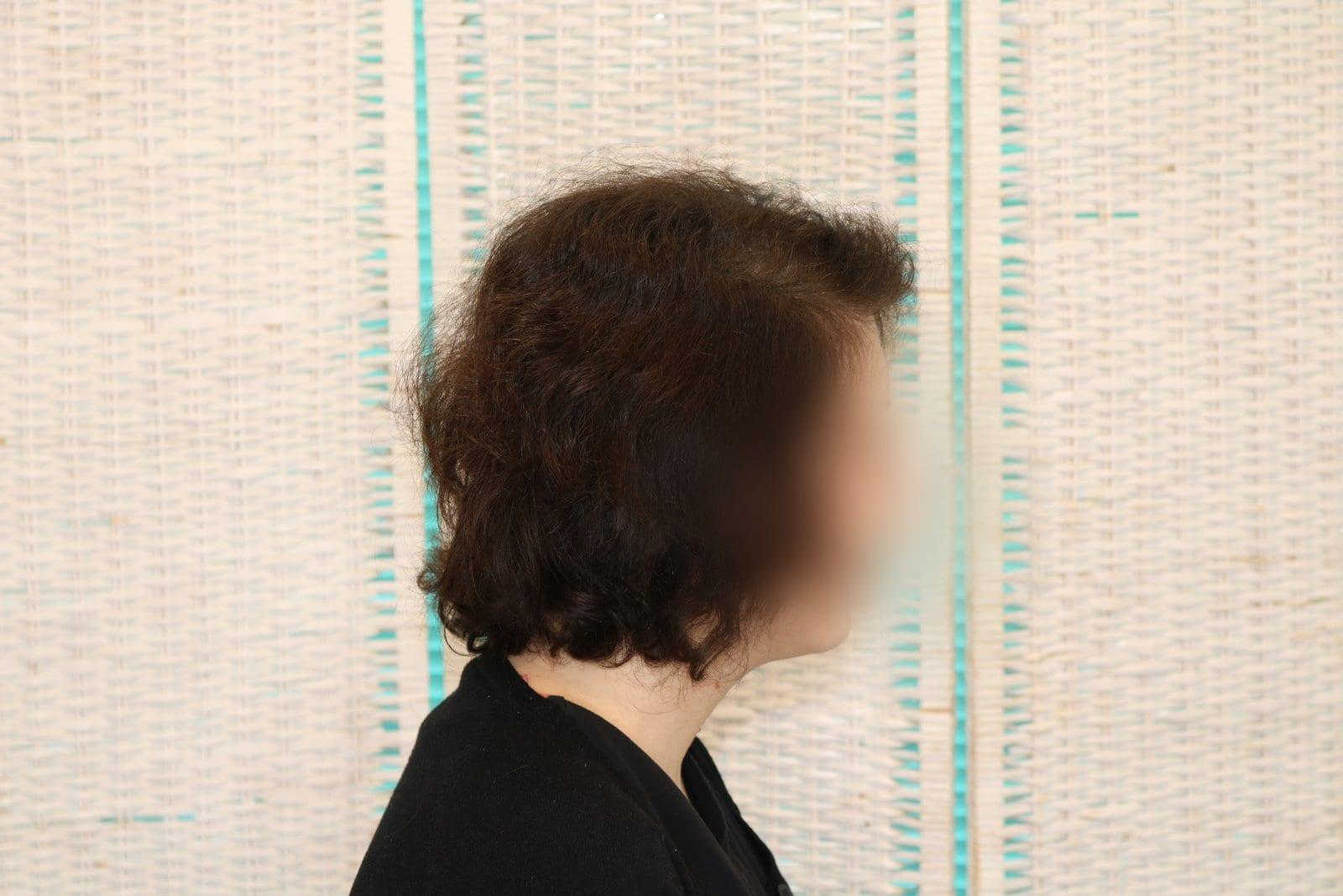 Dopo: tricopigmentazione sezione donna a Firenze — Caso Prima / Dopo #15 (foto 5)