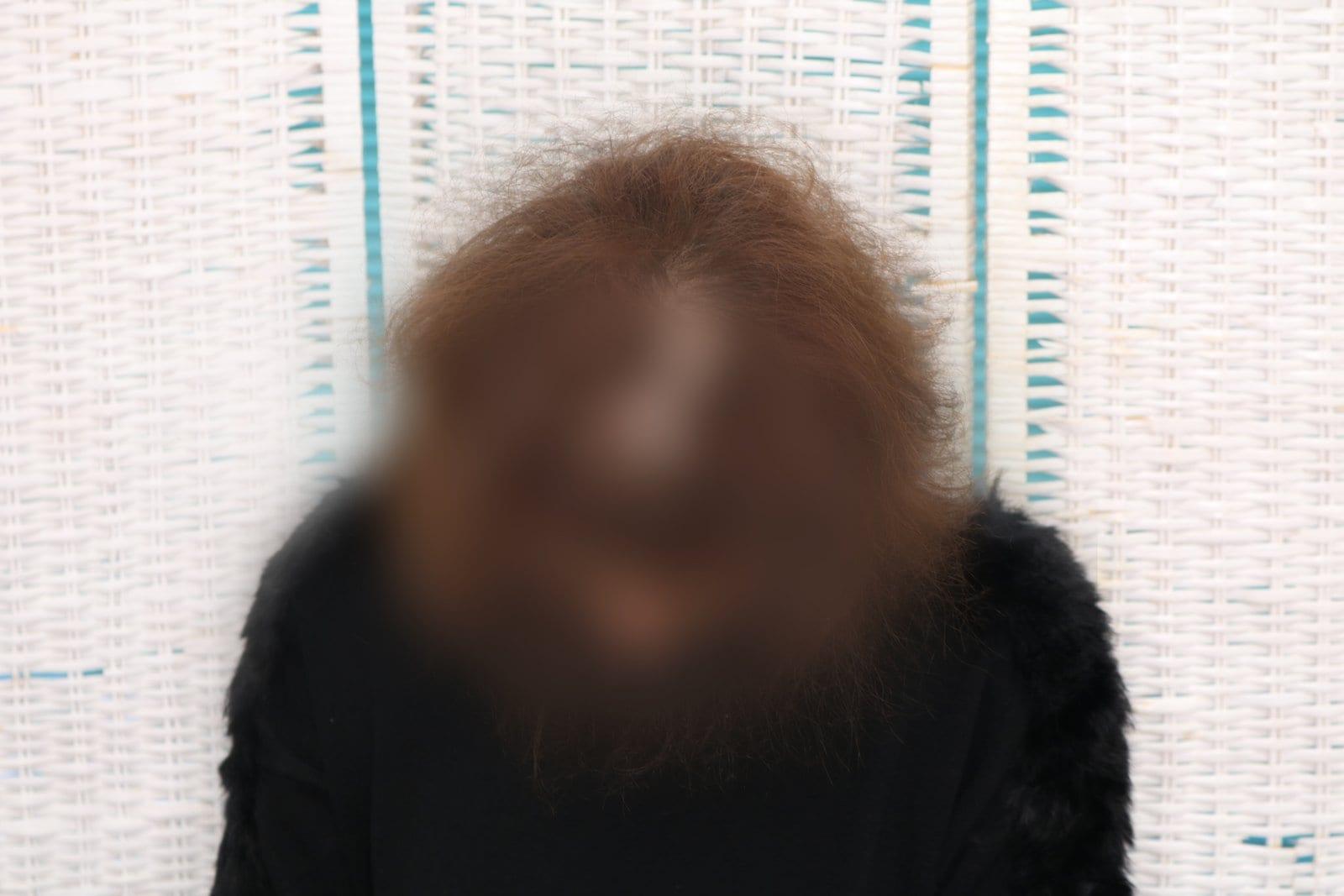 Prima: tricopigmentazione sezione donna a Firenze — Caso Prima / Dopo #15 (foto 1)