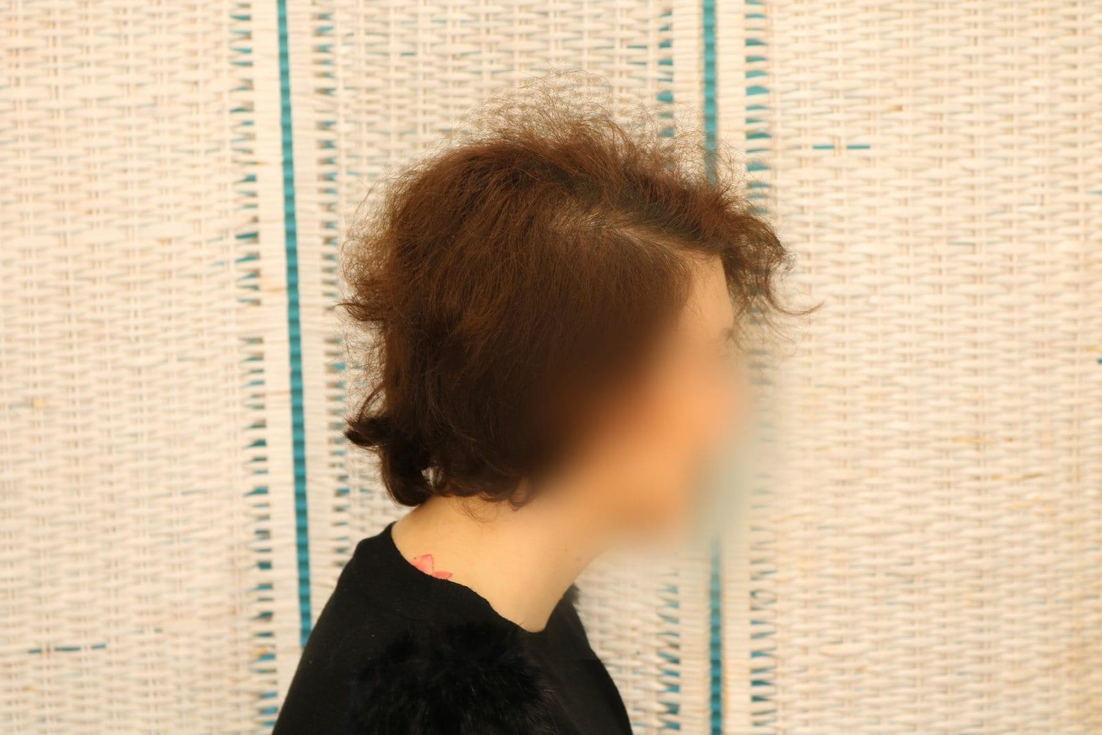 Prima: tricopigmentazione sezione donna a Firenze — Caso Prima / Dopo #15 (foto 2)
