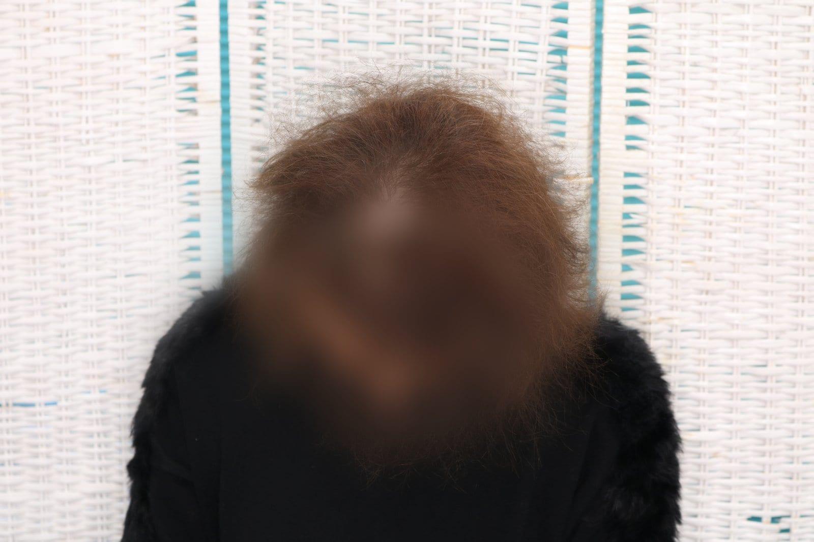 Prima: tricopigmentazione sezione donna a Firenze — Caso Prima / Dopo #15 (foto 3)