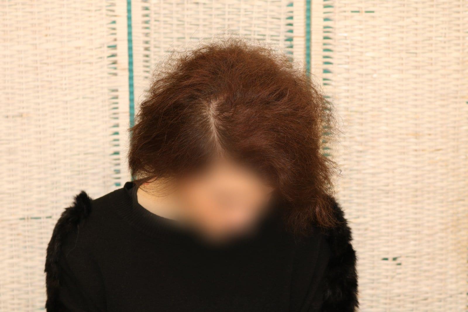Prima: tricopigmentazione sezione donna a Firenze — Caso Prima / Dopo #15 (foto 4)