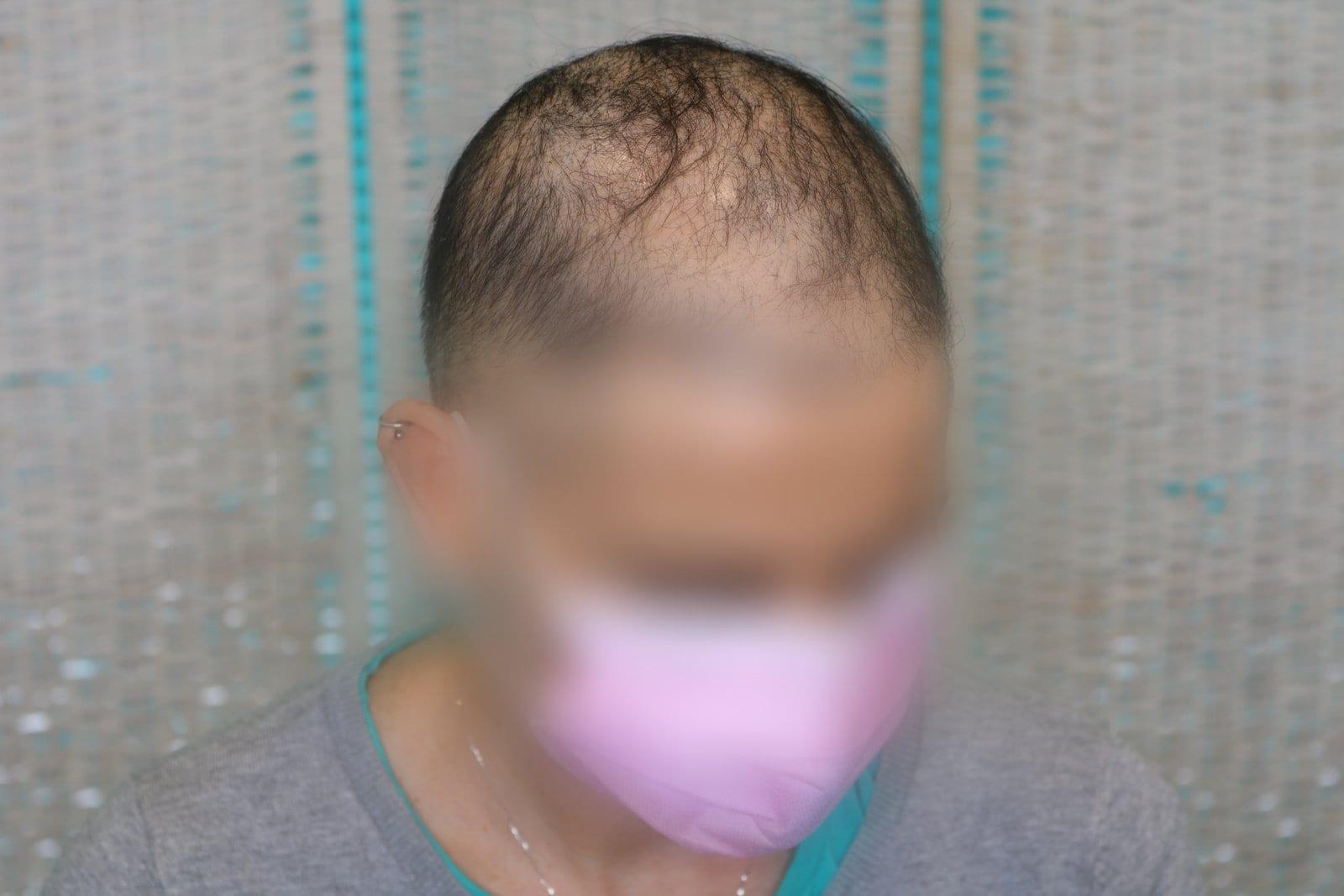 Prima: tricopigmentazione sezione donna a Firenze — Caso Prima / Dopo #16 (foto 1)