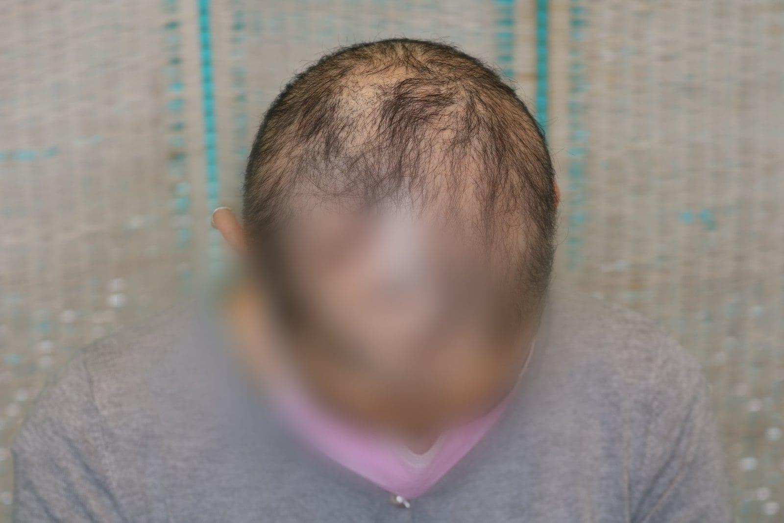 Prima: tricopigmentazione sezione donna a Firenze — Caso Prima / Dopo #16 (foto 2)