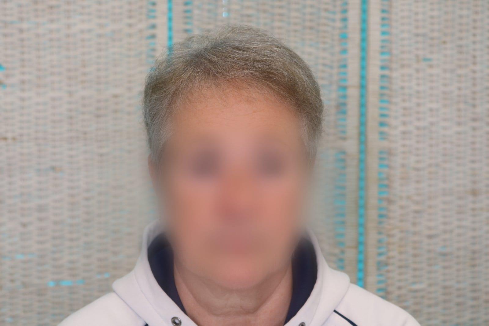 Dopo: tricopigmentazione sezione donna a Firenze — Caso Prima / Dopo #17 (foto 1)