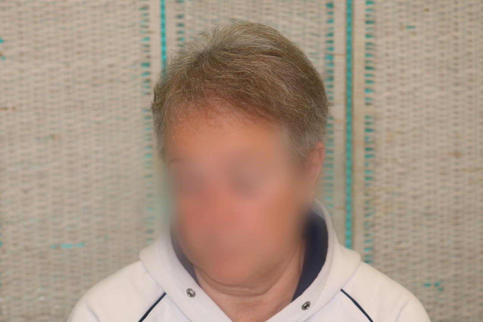 Dopo: tricopigmentazione sezione donna a Firenze — Caso Prima / Dopo #17 (foto 4)