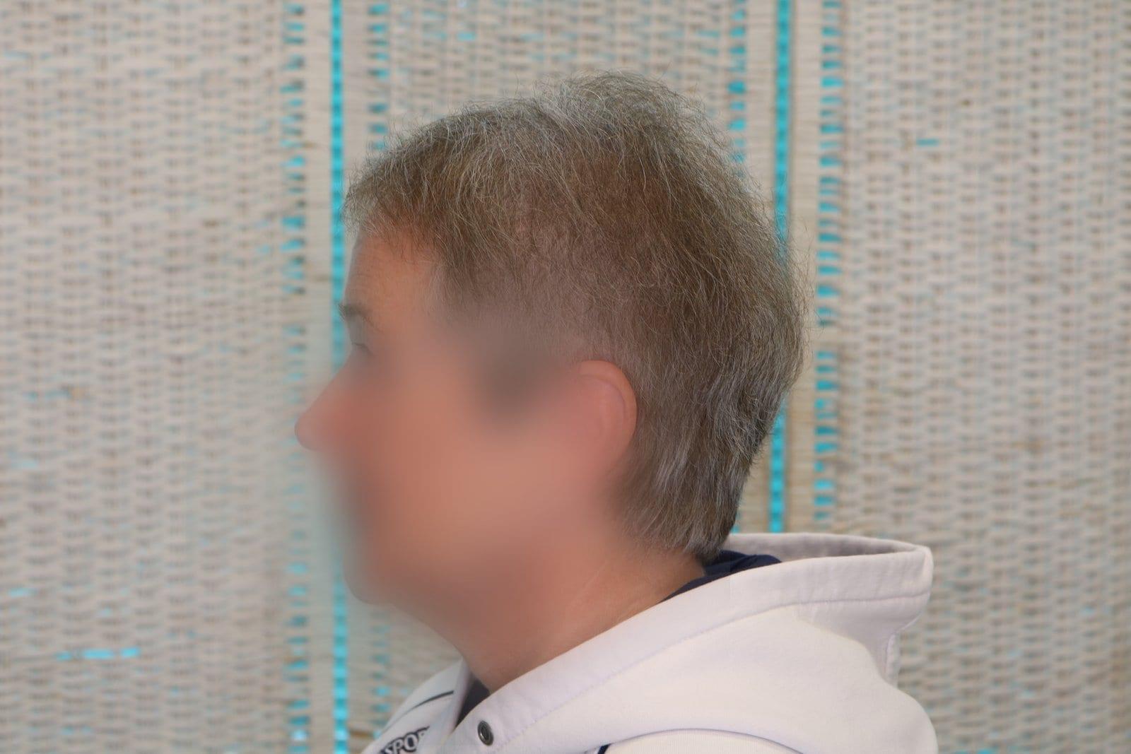 Dopo: tricopigmentazione sezione donna a Firenze — Caso Prima / Dopo #17 (foto 6)