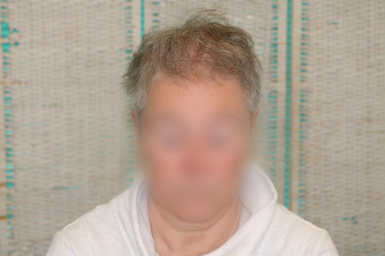 Prima: tricopigmentazione sezione donna a Firenze — Caso Prima / Dopo #17 (foto 1)