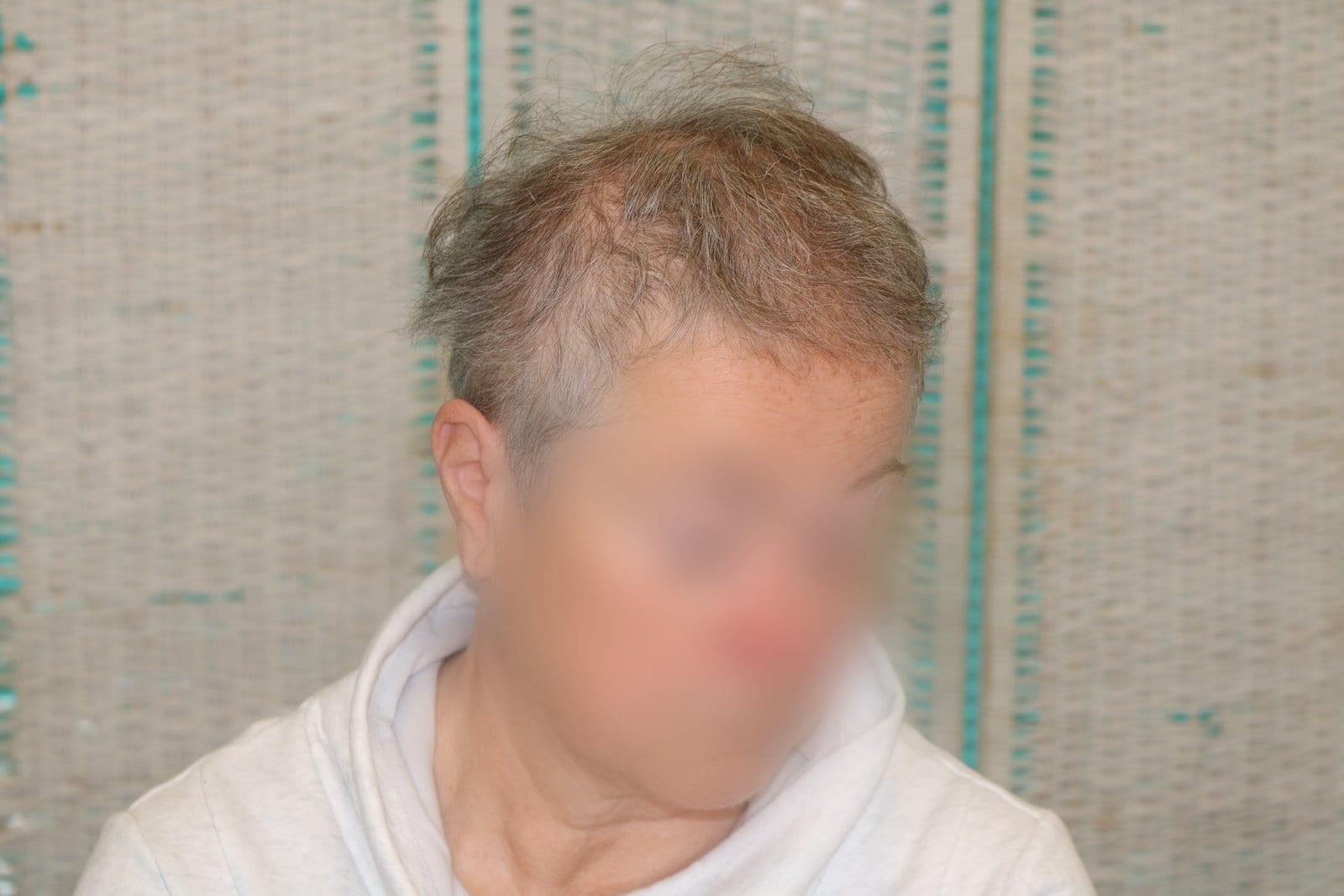 Prima: tricopigmentazione sezione donna a Firenze — Caso Prima / Dopo #17 (foto 2)