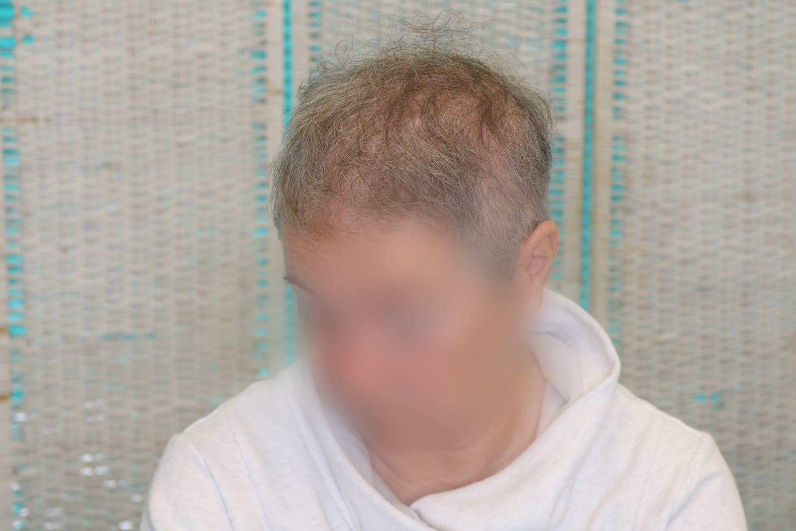 Prima: tricopigmentazione sezione donna a Firenze — Caso Prima / Dopo #17 (foto 3)