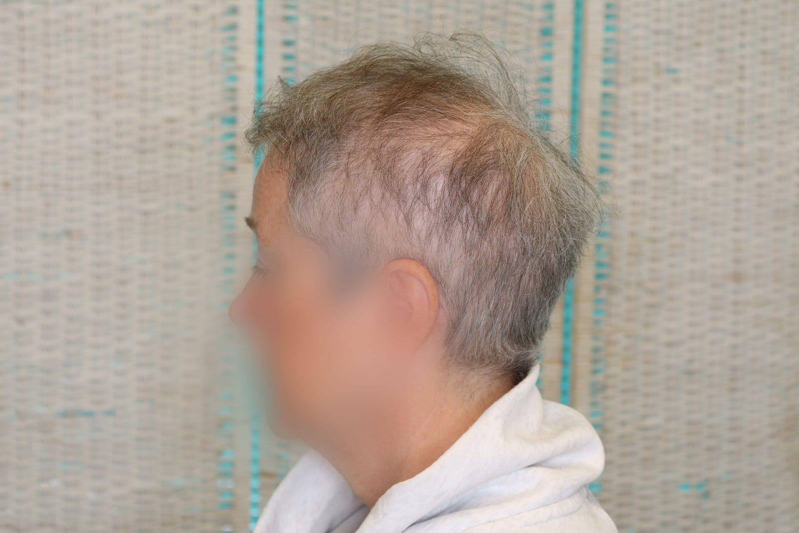 Prima: tricopigmentazione sezione donna a Firenze — Caso Prima / Dopo #17 (foto 8)
