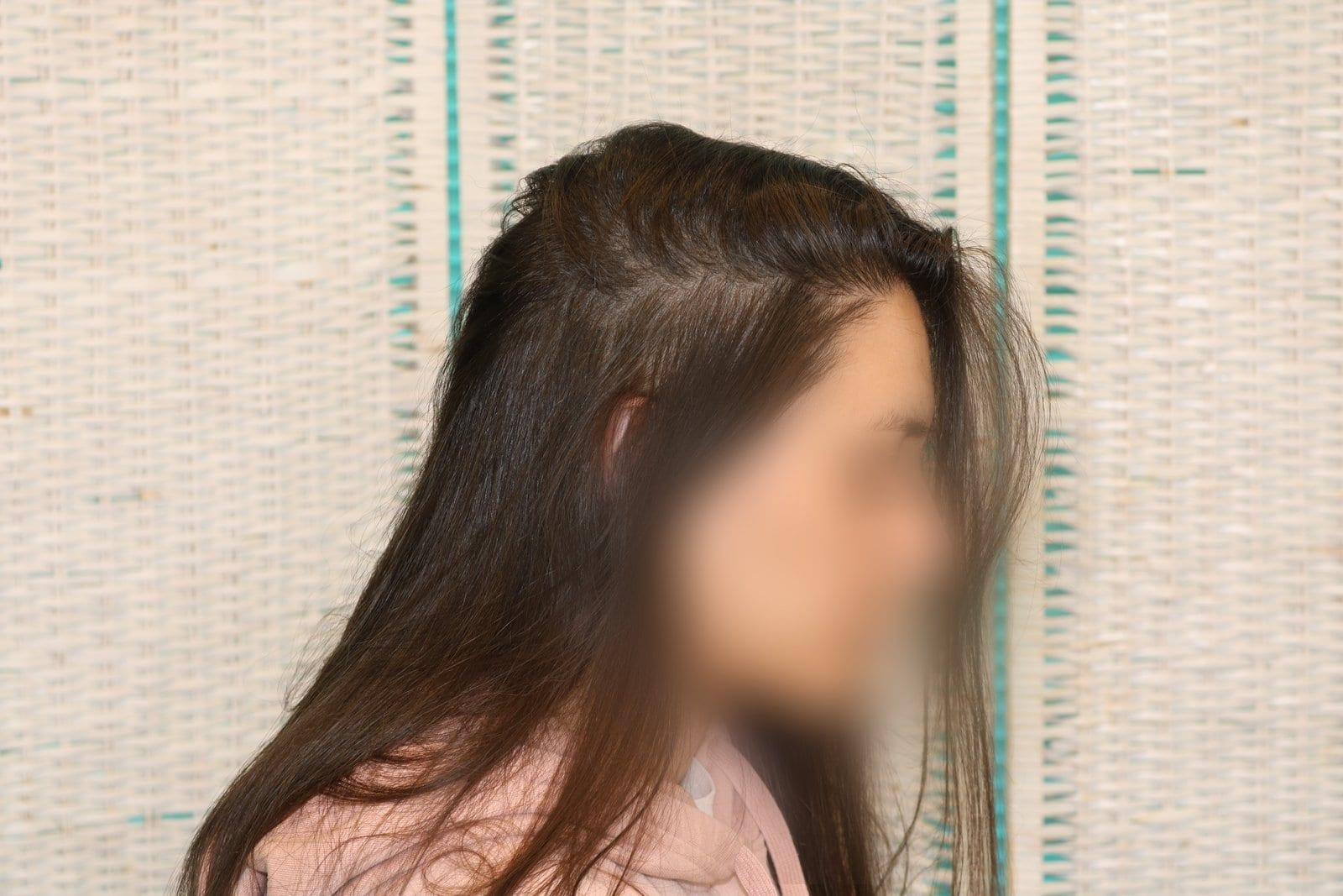 Dopo: tricopigmentazione sezione donna a Firenze — Caso Prima / Dopo #18 (foto 2)