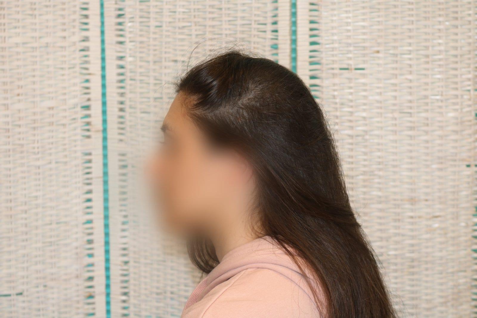 Dopo: tricopigmentazione sezione donna a Firenze — Caso Prima / Dopo #18 (foto 4)