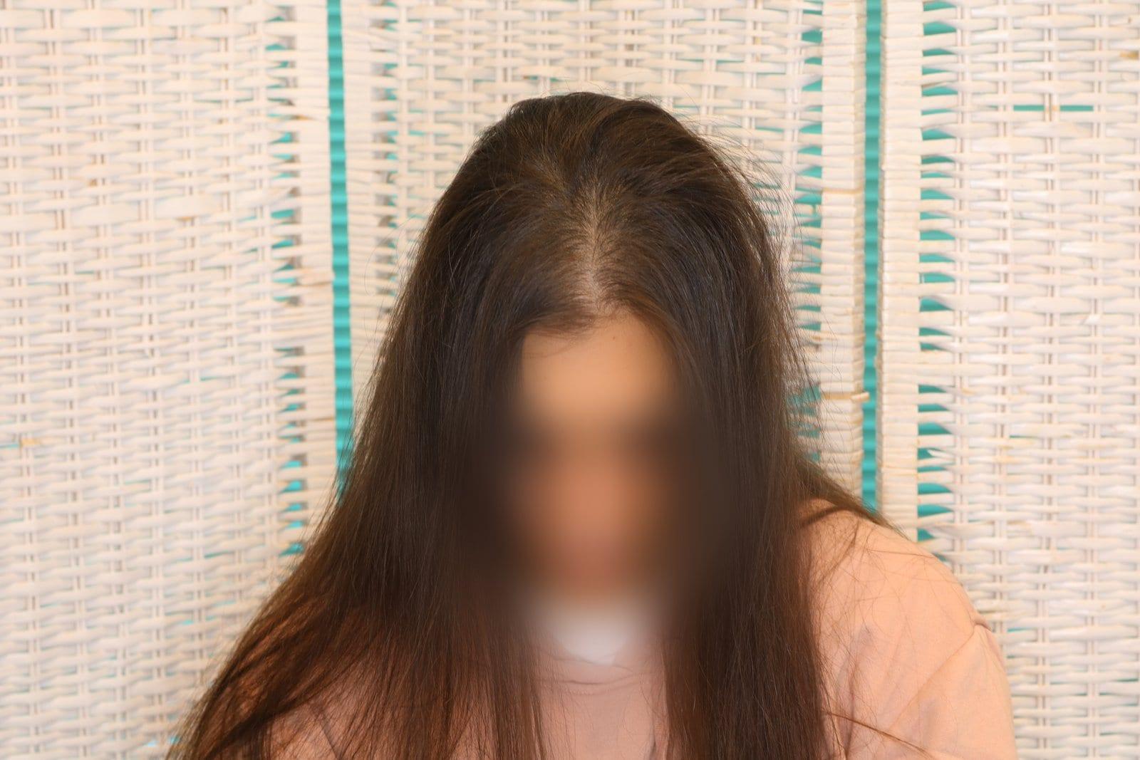 Dopo: tricopigmentazione sezione donna a Firenze — Caso Prima / Dopo #18 (foto 7)