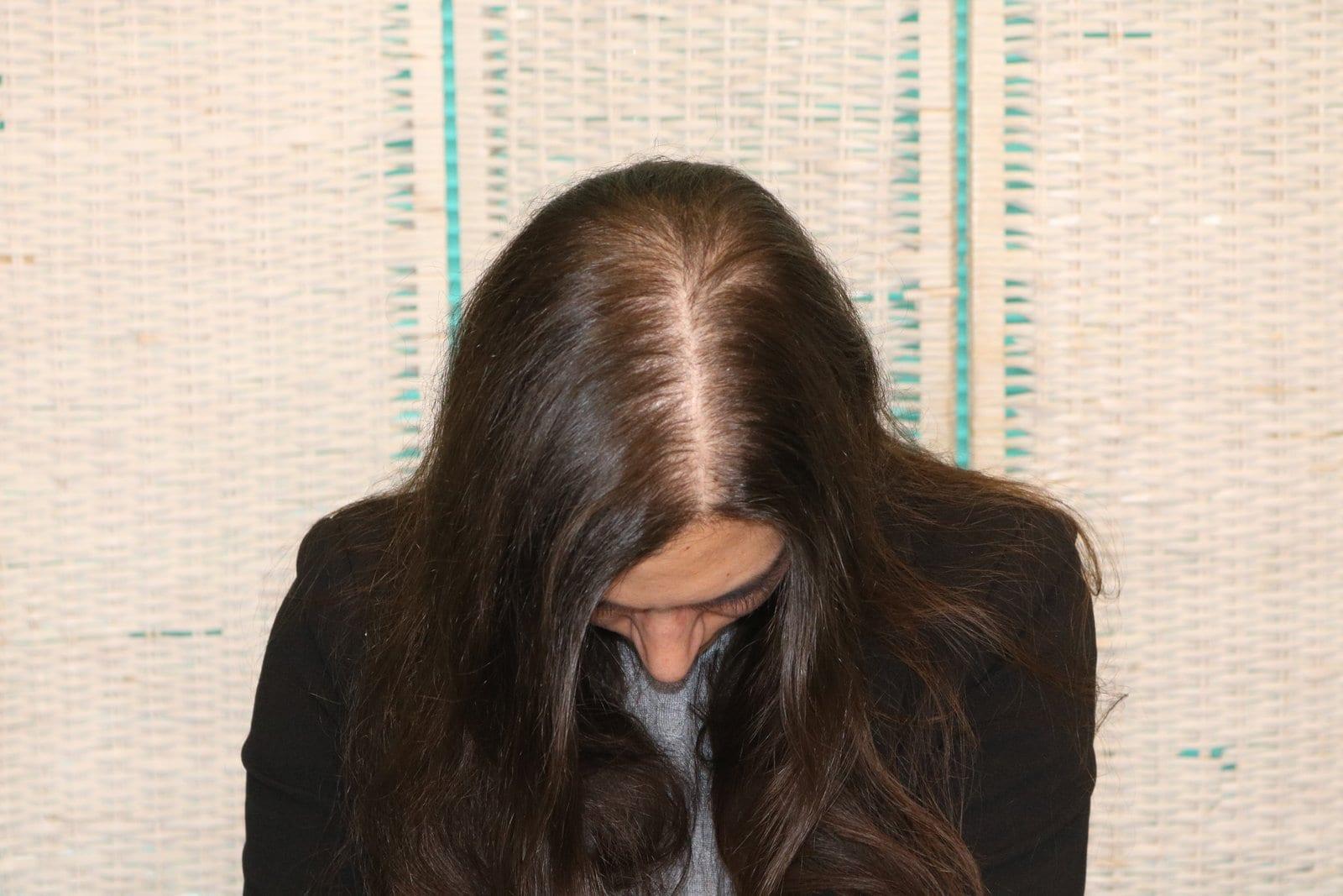 Prima: tricopigmentazione sezione donna a Firenze — Caso Prima / Dopo #18 (foto 1)