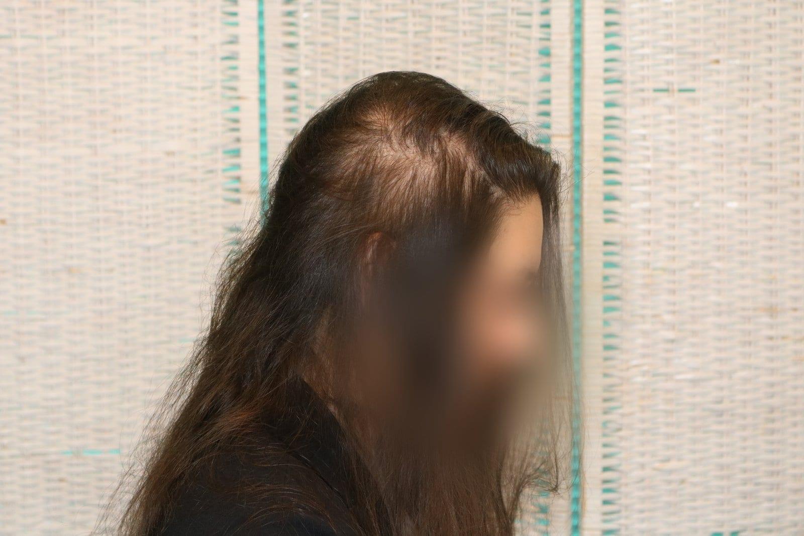 Prima: tricopigmentazione sezione donna a Firenze — Caso Prima / Dopo #18 (foto 2)
