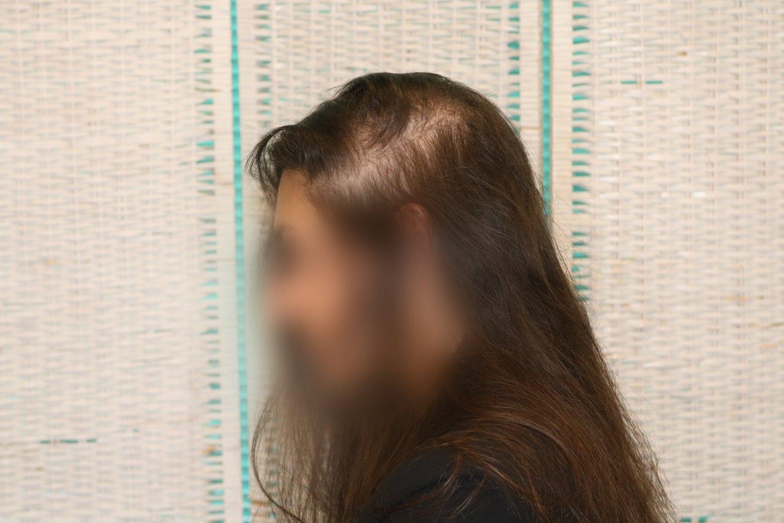 Prima: tricopigmentazione sezione donna a Firenze — Caso Prima / Dopo #18 (foto 3)
