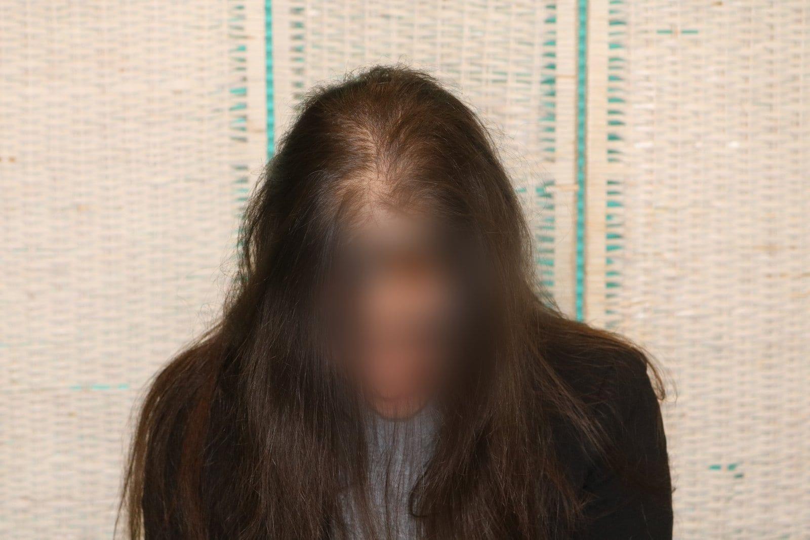 Prima: tricopigmentazione sezione donna a Firenze — Caso Prima / Dopo #18 (foto 4)