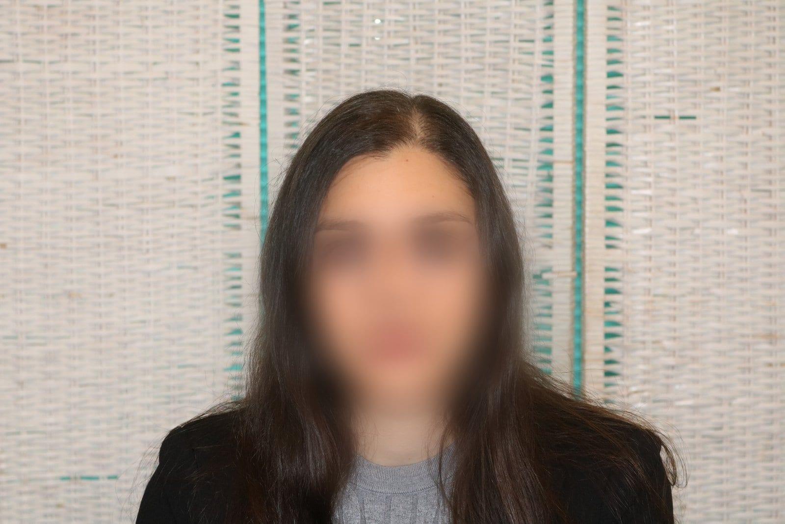 Prima: tricopigmentazione sezione donna a Firenze — Caso Prima / Dopo #18 (foto 5)
