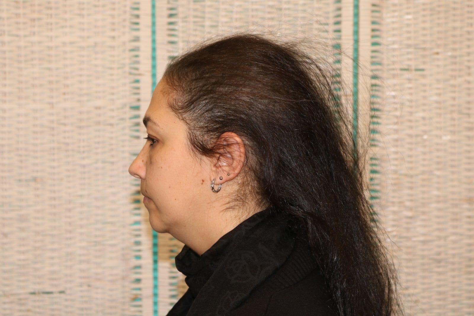 Dopo: tricopigmentazione sezione donna a Firenze — Caso Prima / Dopo #19 (foto 10)