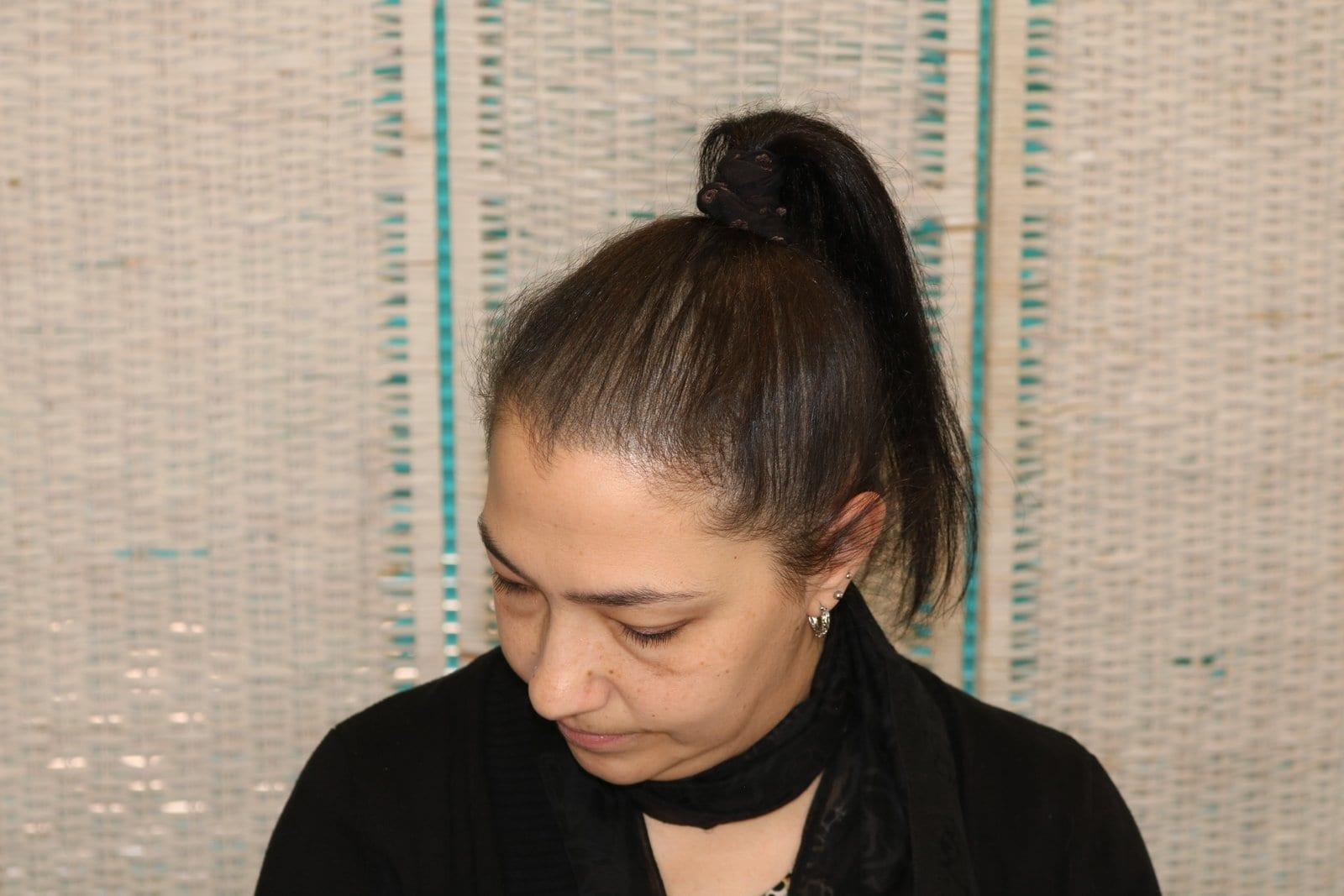 Dopo: tricopigmentazione sezione donna a Firenze — Caso Prima / Dopo #19 (foto 6)