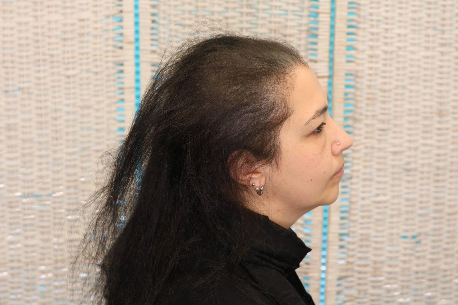 Dopo: tricopigmentazione sezione donna a Firenze — Caso Prima / Dopo #19 (foto 7)