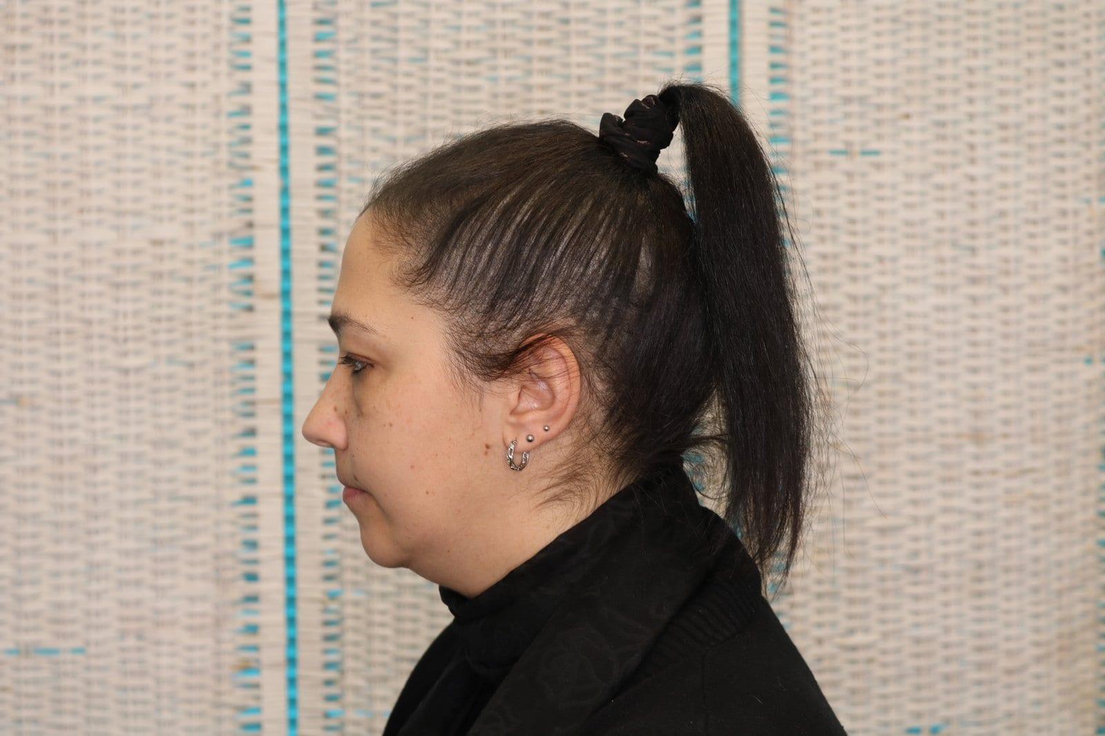 Dopo: tricopigmentazione sezione donna a Firenze — Caso Prima / Dopo #19 (foto 8)