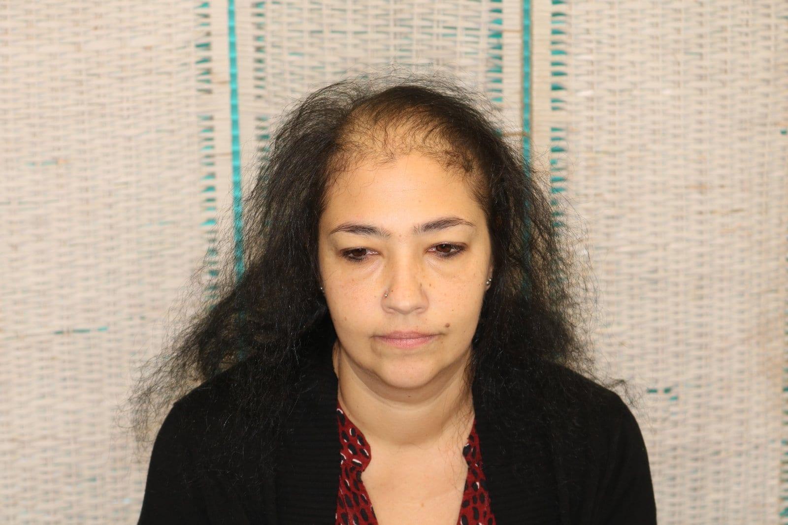 Prima: tricopigmentazione sezione donna a Firenze — Caso Prima / Dopo #19 (foto 5)