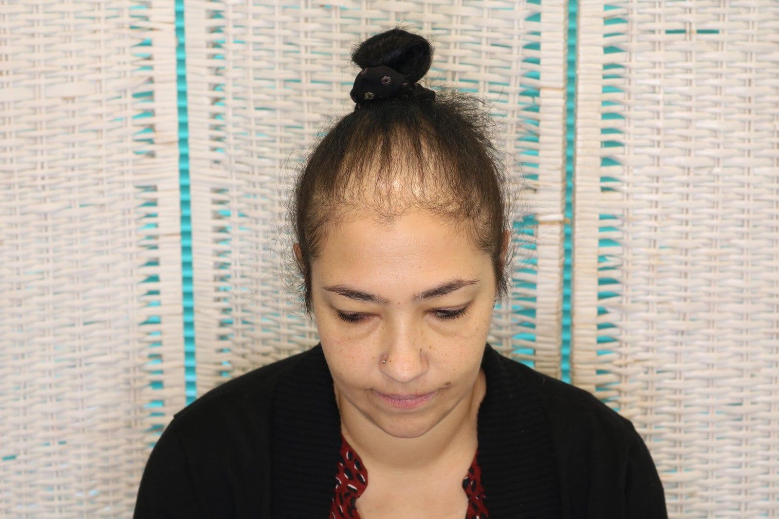 Prima: tricopigmentazione sezione donna a Firenze — Caso Prima / Dopo #19 (foto 7)