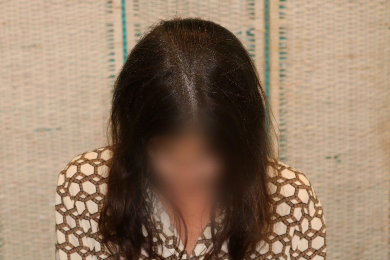 Dopo: tricopigmentazione sezione donna a Firenze — Caso Prima / Dopo #20 (foto 6)