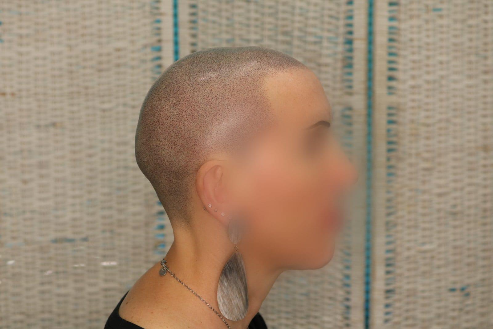 Dopo: tricopigmentazione sezione donna a Firenze — Caso Prima / Dopo #5 (foto 2)