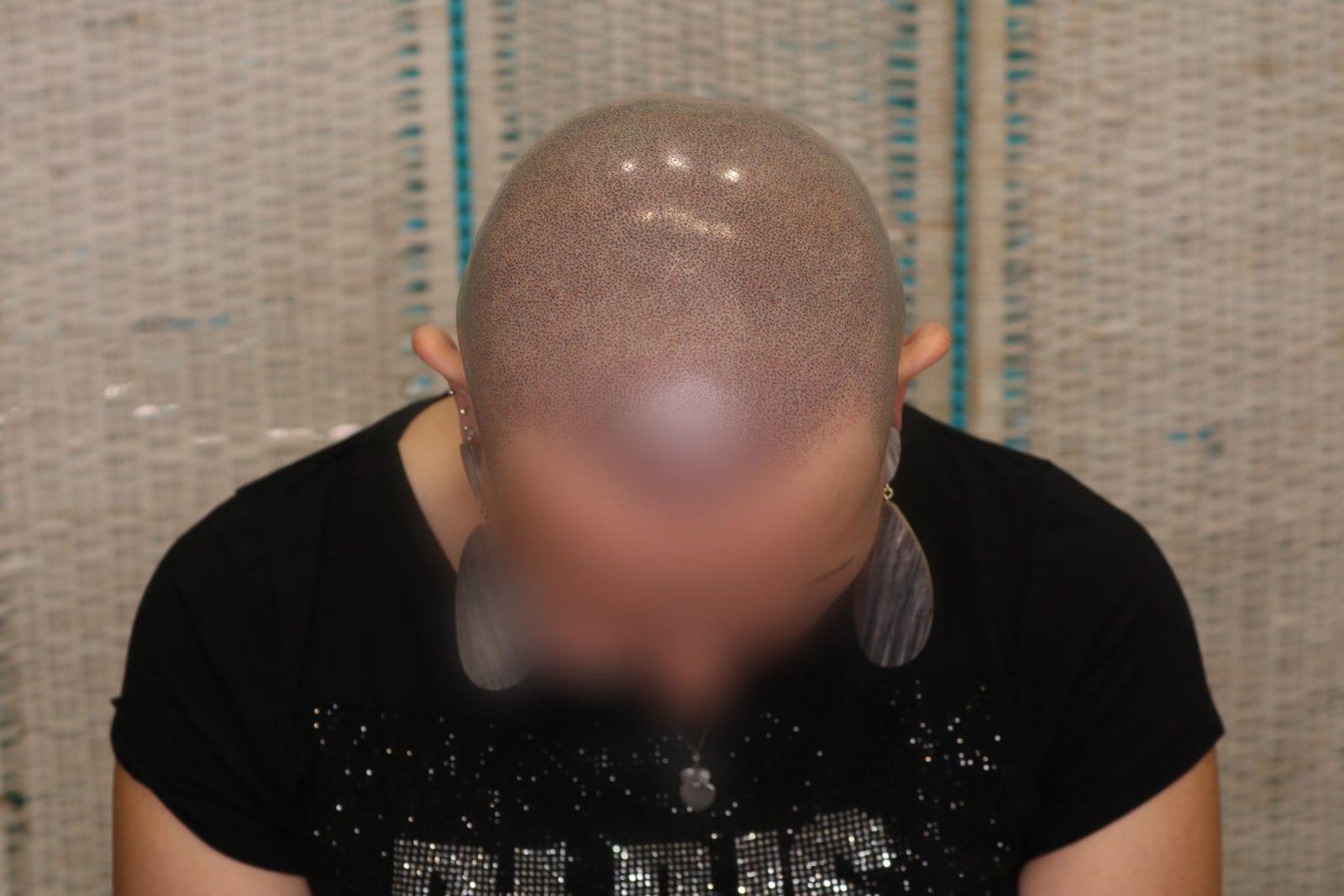 Dopo: tricopigmentazione sezione donna a Firenze — Caso Prima / Dopo #5 (foto 3)