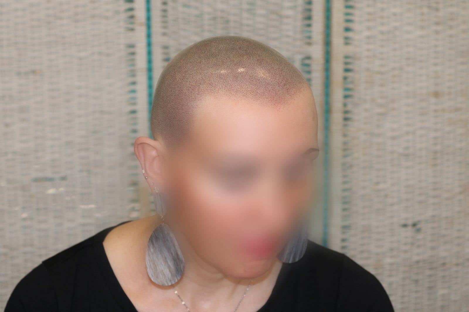 Dopo: tricopigmentazione sezione donna a Firenze — Caso Prima / Dopo #5 (foto 4)