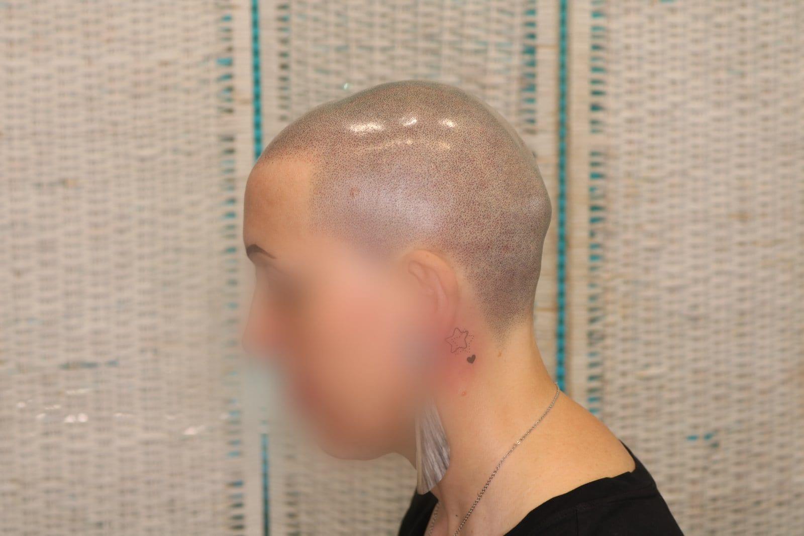 Dopo: tricopigmentazione sezione donna a Firenze — Caso Prima / Dopo #5 (foto 5)